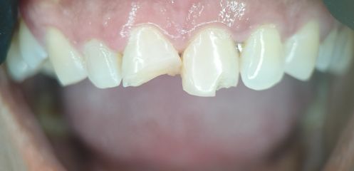 Large fillings or fractured teeth